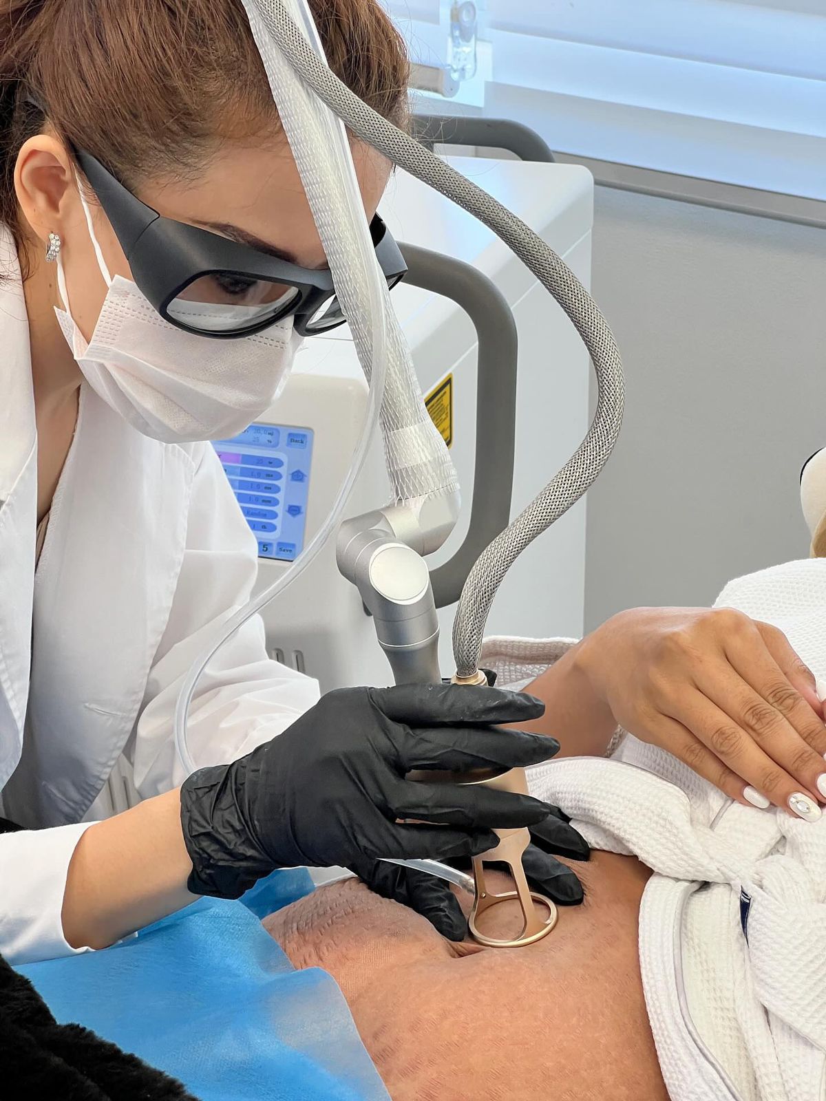 CO2 Laser for Stretch Marks