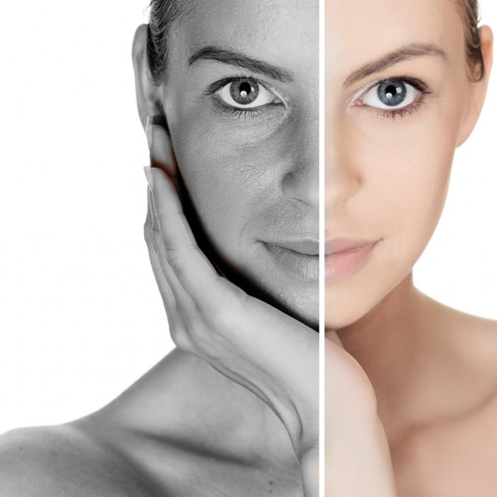 Pico Laser: Skin Rejuvenation