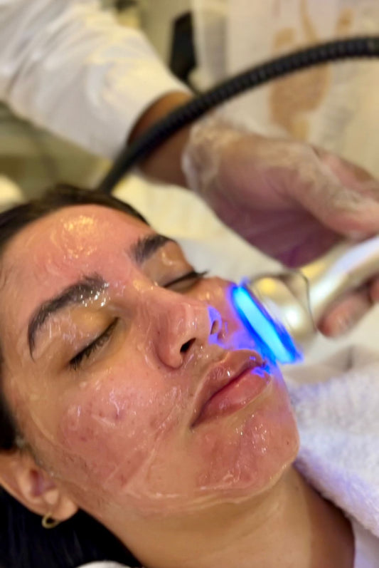 4 in 1 Ultimate Acne treatment