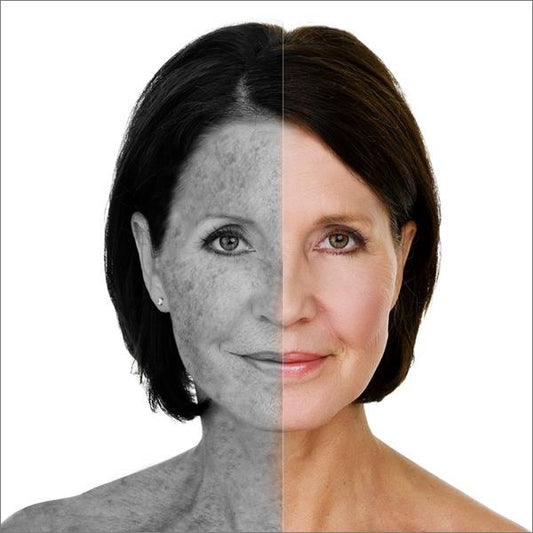 Laser Pigmentatios Treatment
